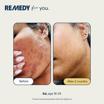 Remedy Skin Serum for Dark Spots and Discoloration 1 fl oz - Imperfect Box