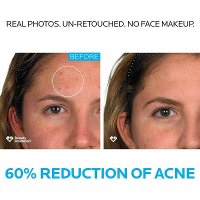 La Roche Posay Effaclar Dermatological Acne Treatment 3-Step System Kit Medicated Gel Cleanser 7.5 fl oz - Imperfect Box