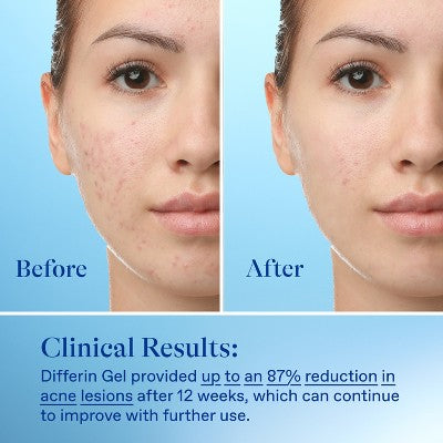 Differin Acne Retinoid Face and Body Treatment Gel Adapalene 0.1% 45g - Imperfect Box