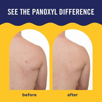 PanOxyl Acne Banishing Body Spray 2% Salicylic Acid 6oz - Imperfect Container