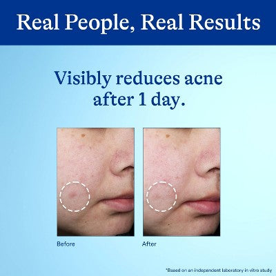 Differin 10% Benzoyl Peroxide Acne Spot Treatment - Imperfect Box
